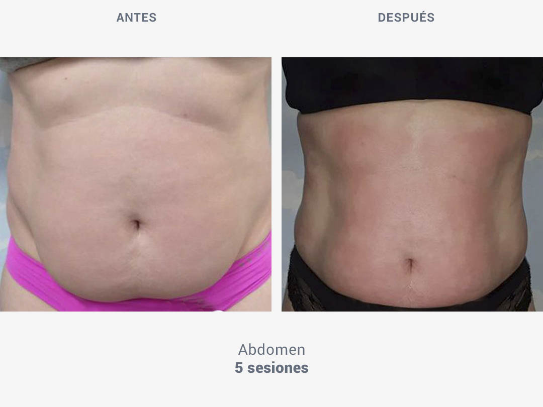 Imágenes del antes y después tras 5 sesiones de tratamiento en abdomen con Tei System de ROSS