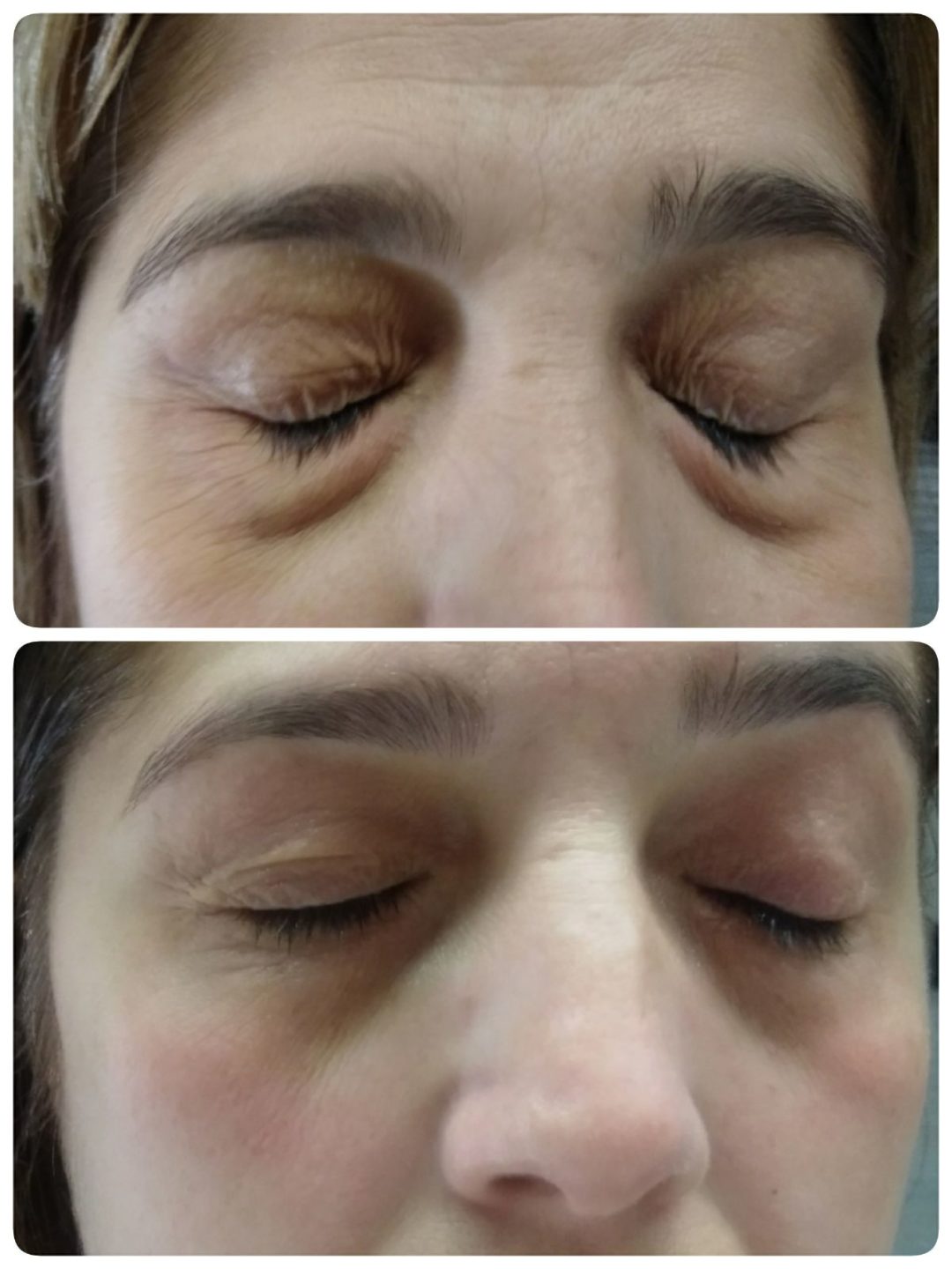 Imagen antes-después Resultados tratamiento Binary System en Bolsas Ojos